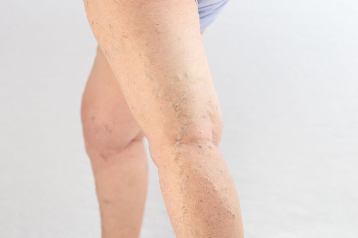 11 Complications of Untreated Varicose Veins You Should Know Vein Envy™